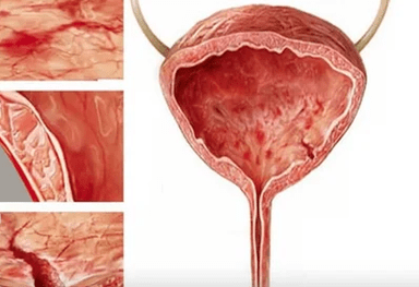 Reasons for the development of cystitis in women